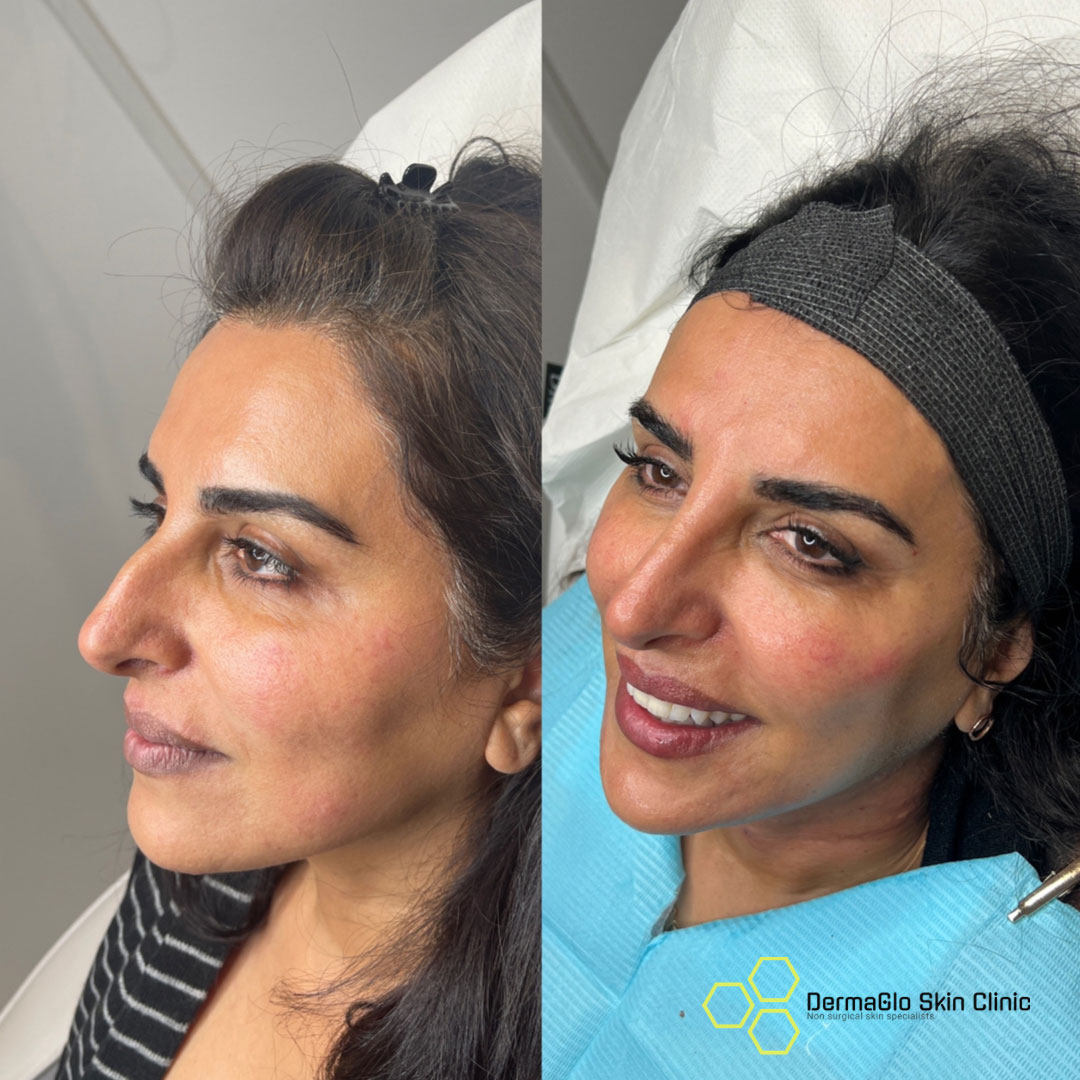 8 point facelift before after 4