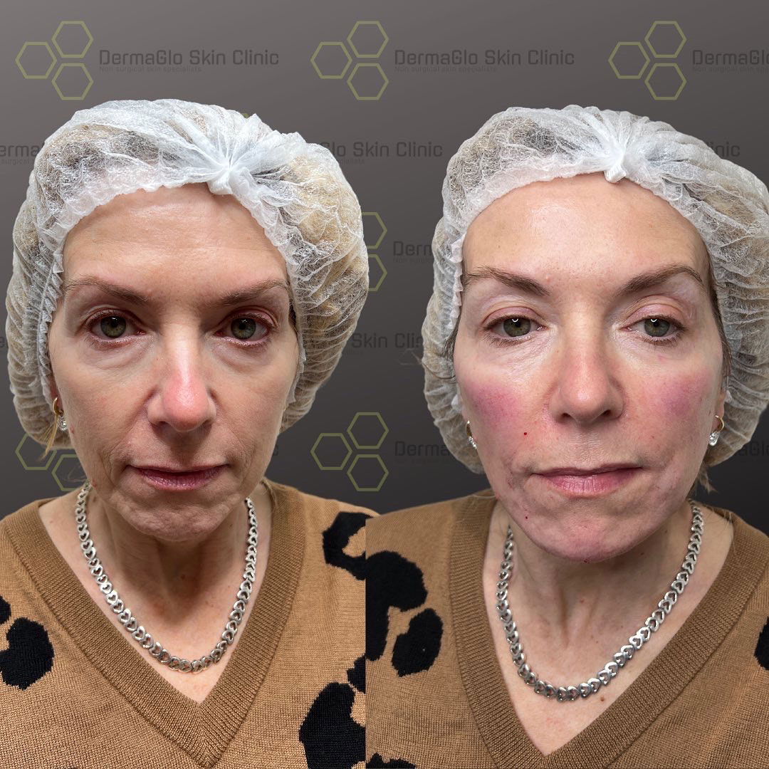 8 point facelift before after 5