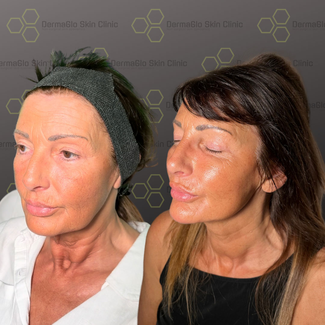 8 point facelift before after 8