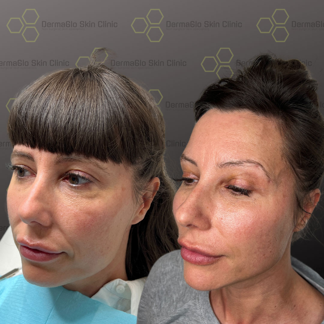 8 point facelift before after 9