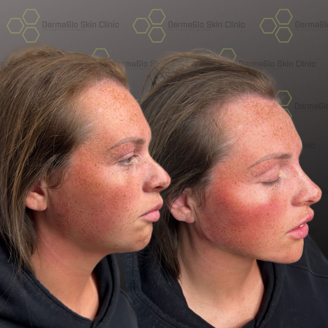 8 point facelift before after 10