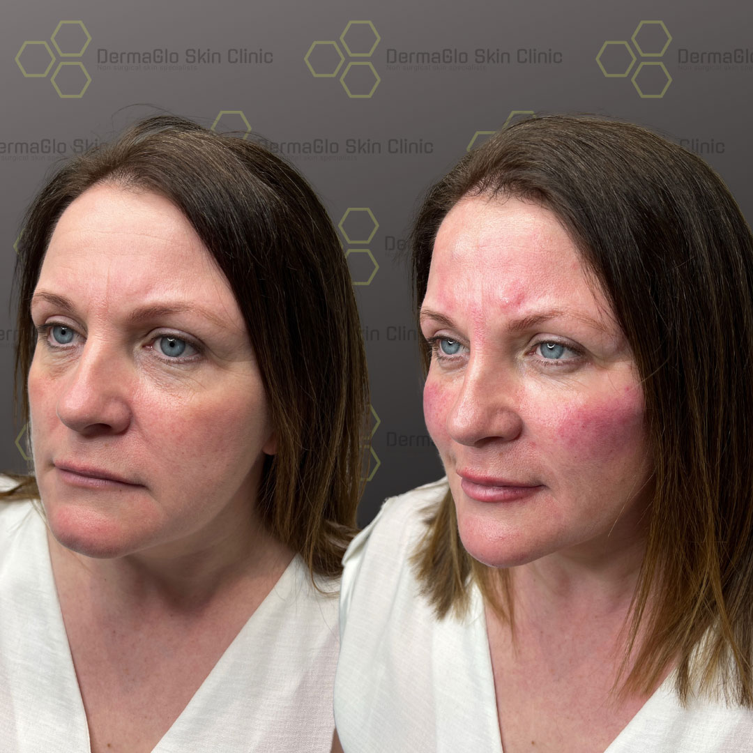 8 point facelift before after 1