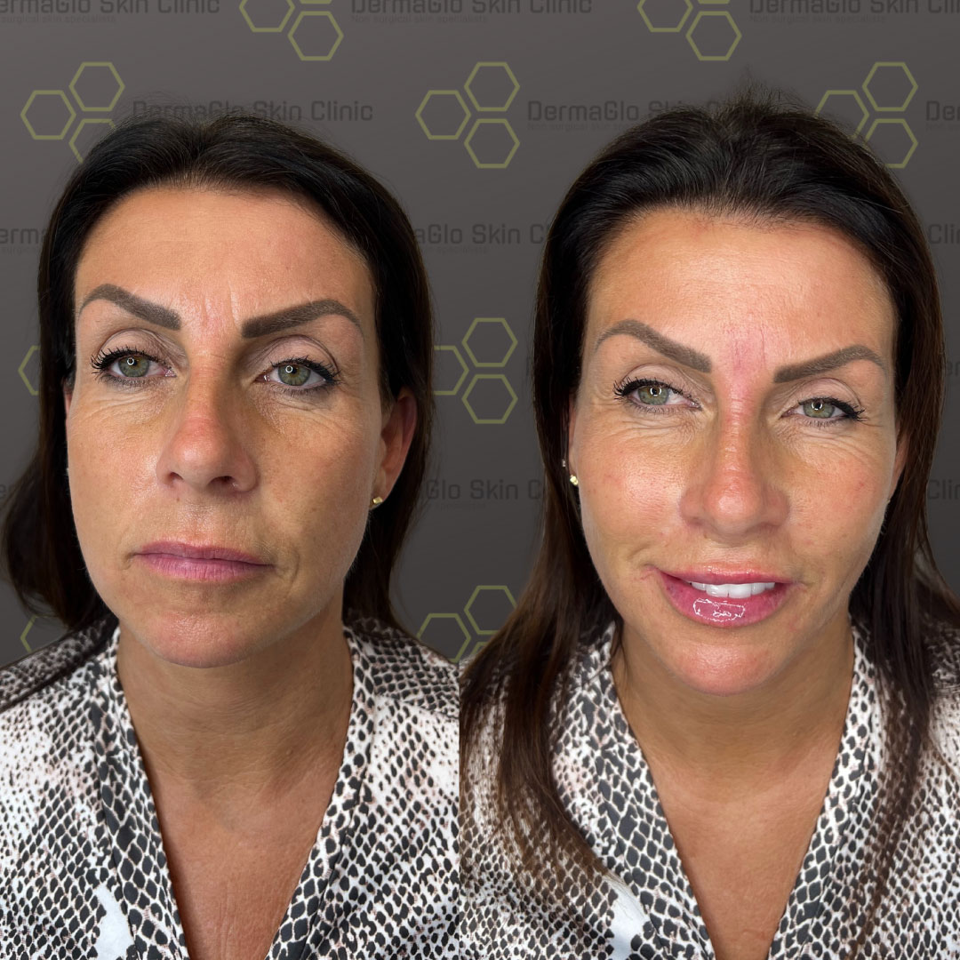 8 point facelift before after 2