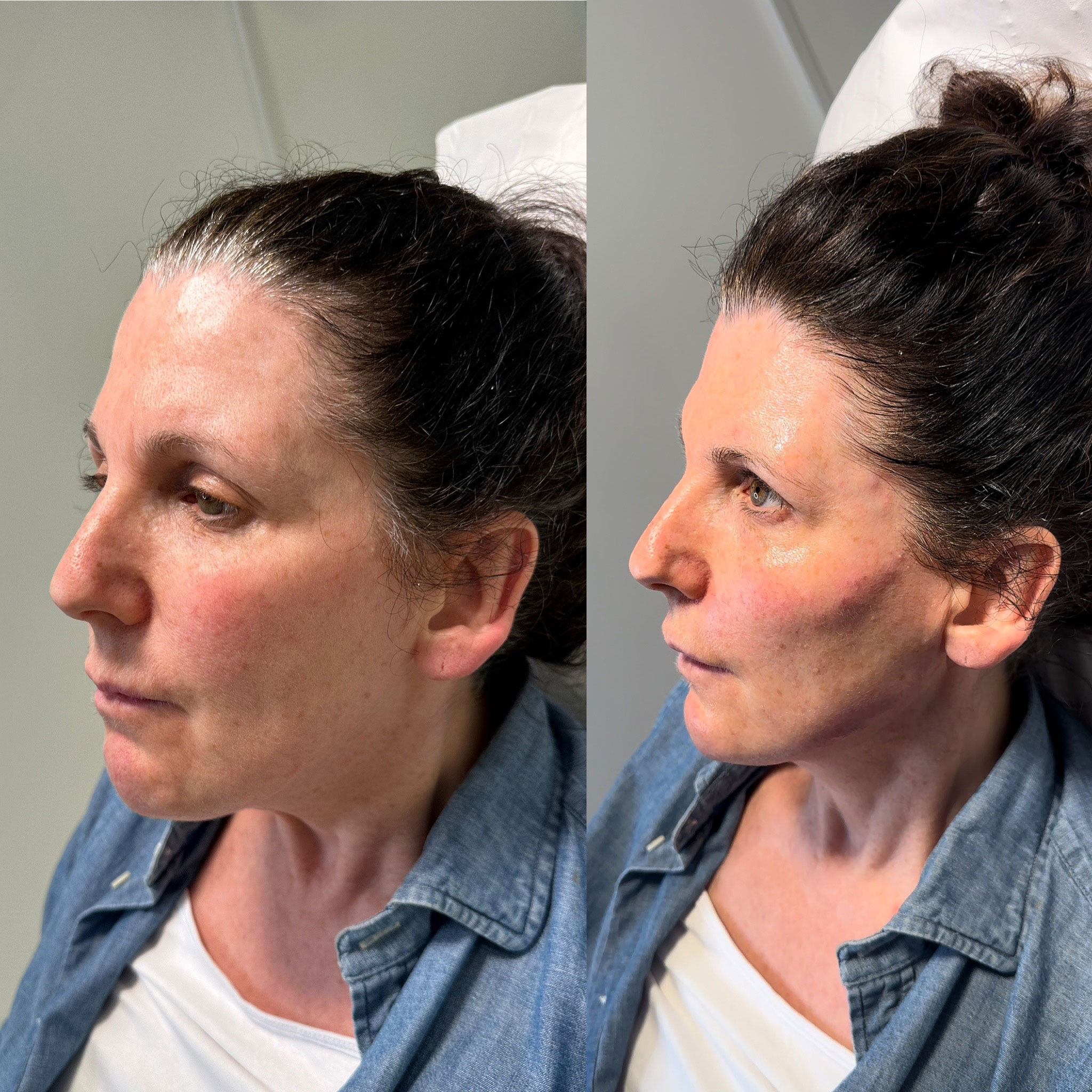 8 point facelift before after 6