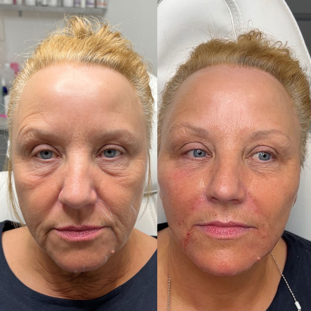 8 point facelift before after 7