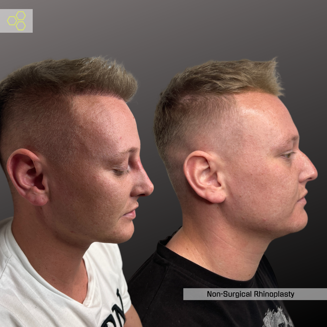 Non-Surgical Rhinoplasty