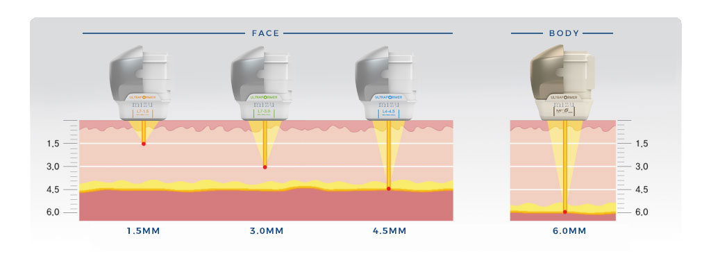Hifu Chin reduction